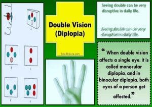 Double Vision Diplopia Causes Tests And Treatment Health Kura