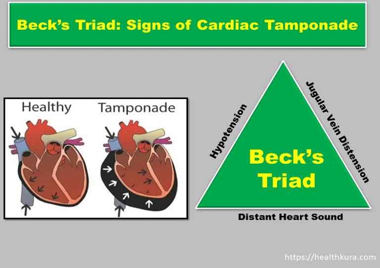 becks-triad-or-cardiac-tamponade-triad