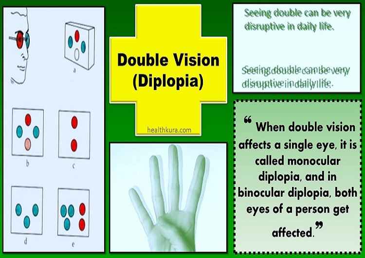 double-vision-diplopia-in-eye