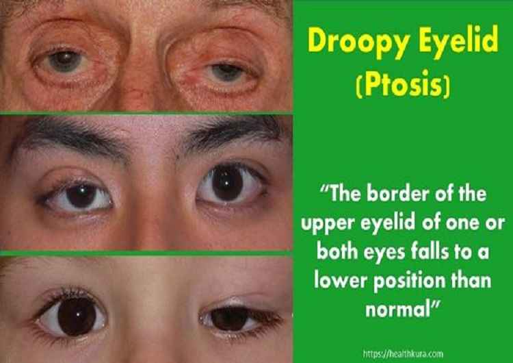 droopy-eyelid-sagging-ptosis-of-eyelid