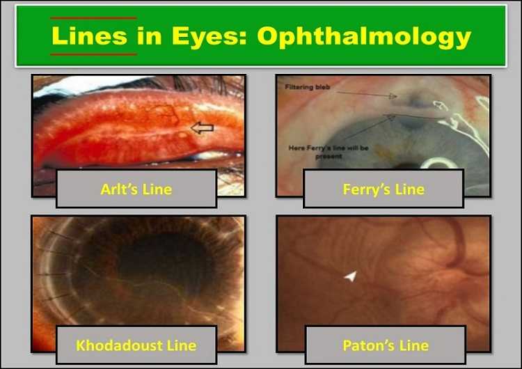 lines-in-eyes-lines-in-ophthalmology
