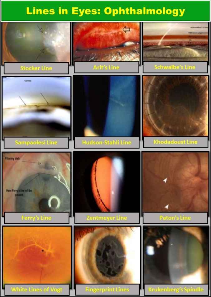 lines-in-eyes-ophthalmology-arlt-vogt-haab-stocker