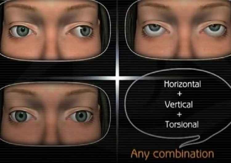 nystagmus-involuntary-eye-movements