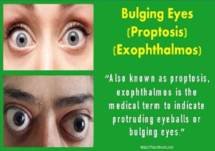 proptosis-bulging-eyes