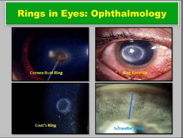 ring-keratitis-coats-rings-in-ophthalmolosy