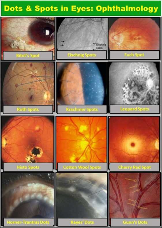 spots-in-eyes-dots-in-eyes-ophthalmology