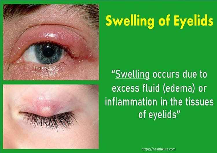 swollen-eyelids-bumps