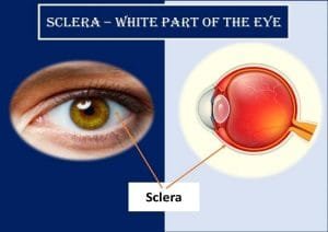 define scleral icterus