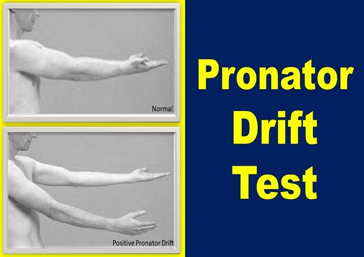 pronator-drift-test-causes-assessment