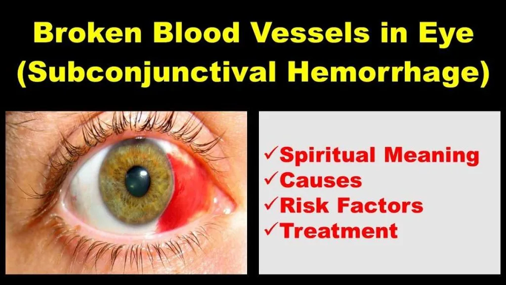 spiritual-meaning-of-broken-blood-vessel-in-eye-subconjunctival-hemorrhage