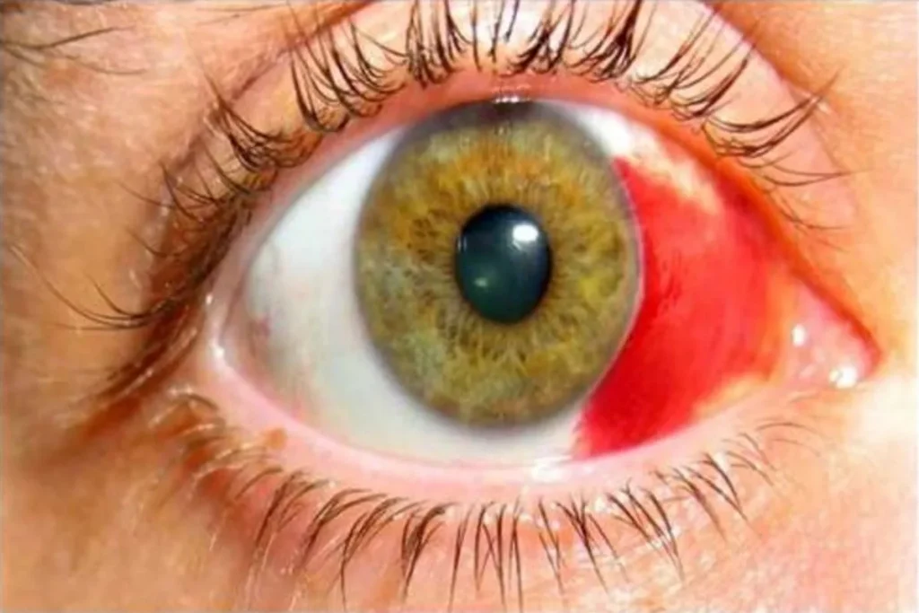 spiritual-meaning-of-broken-blood-vessel-in-eye-subconjunctival-hemorrhage