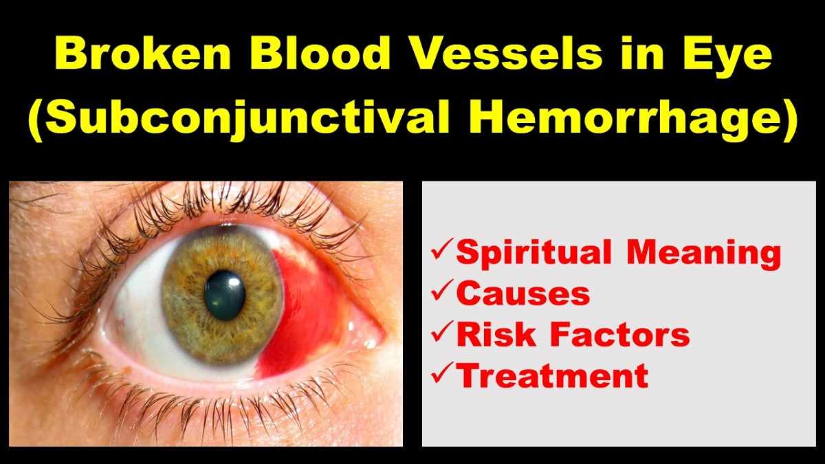 What do Broken Blood Vessels in the Eye Mean?