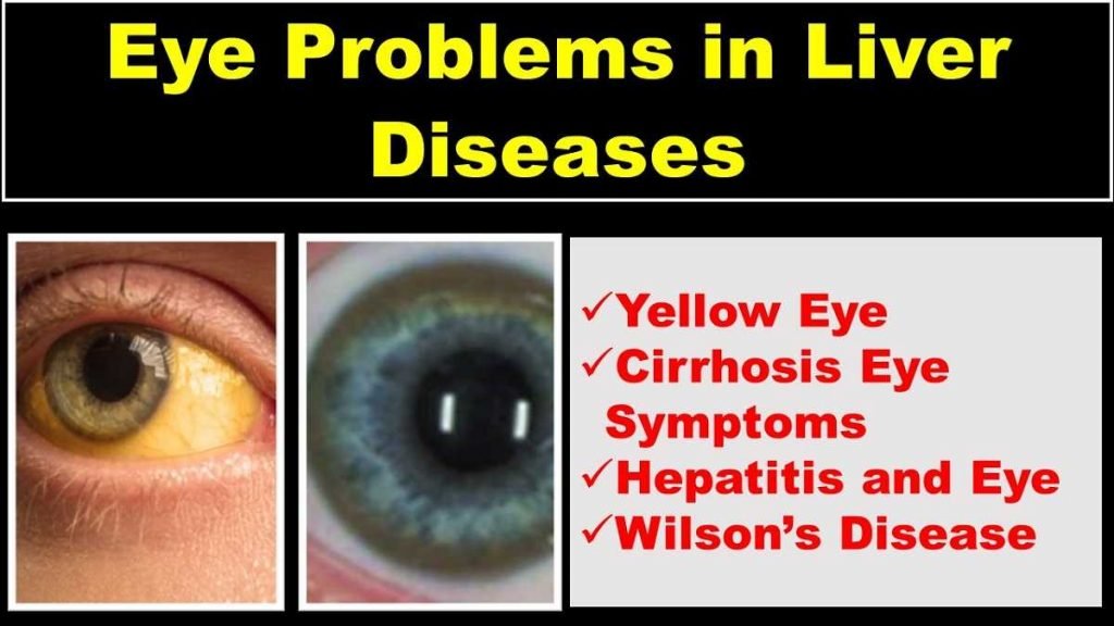 yellow-eye-cirrhosis-symptoms-other-eye-problems-in-liver-diseases-1