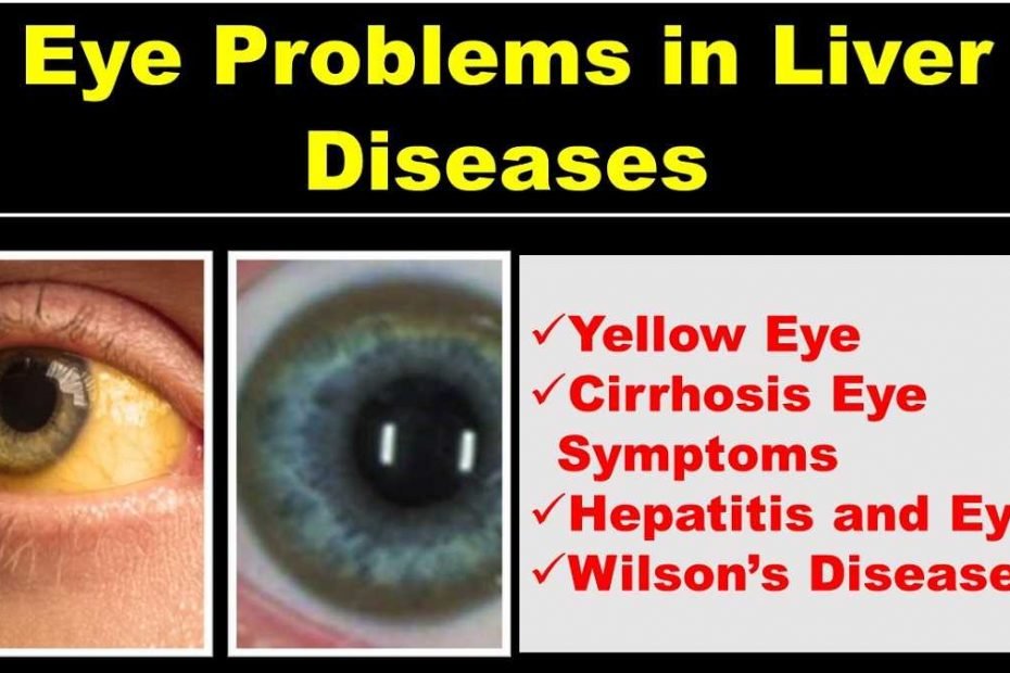 cirrhosis-eye-symptoms-yellow-eye-in-liver-diseases-health-kura