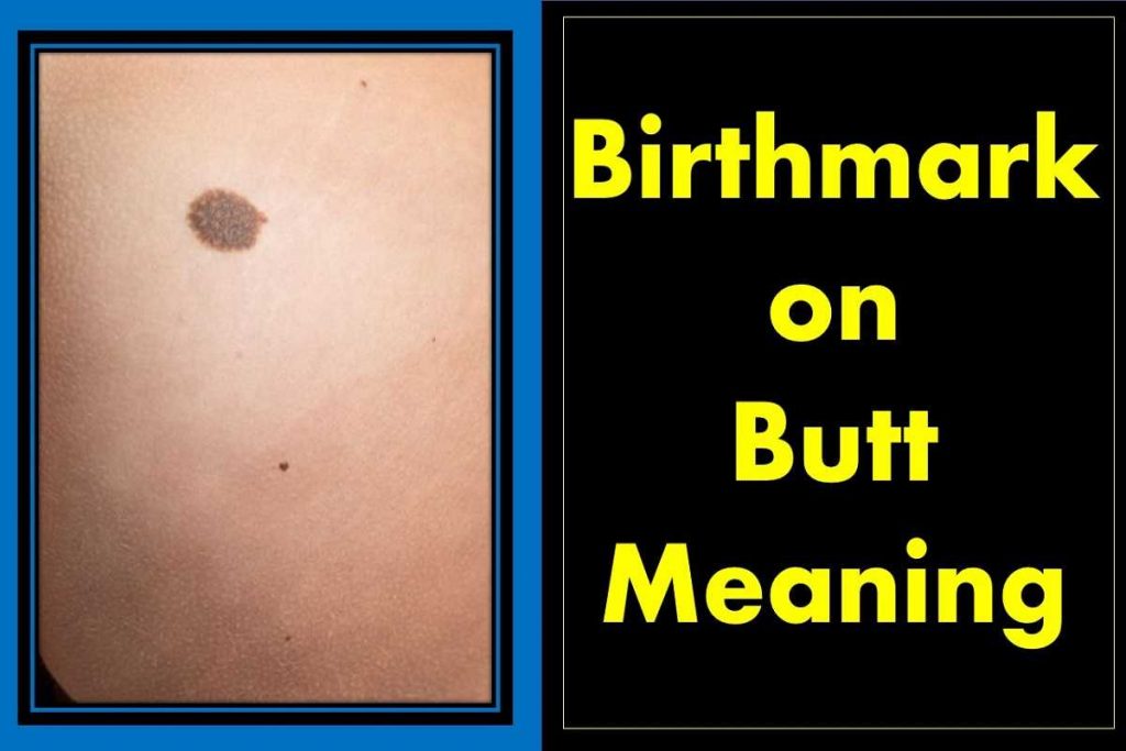 birthmark-on-buttocks-meaning-female-male-right-left