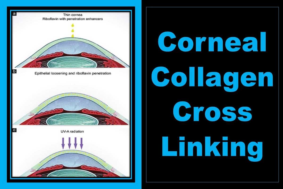 corneal-collagen-cross-linking-uses-types-procedure