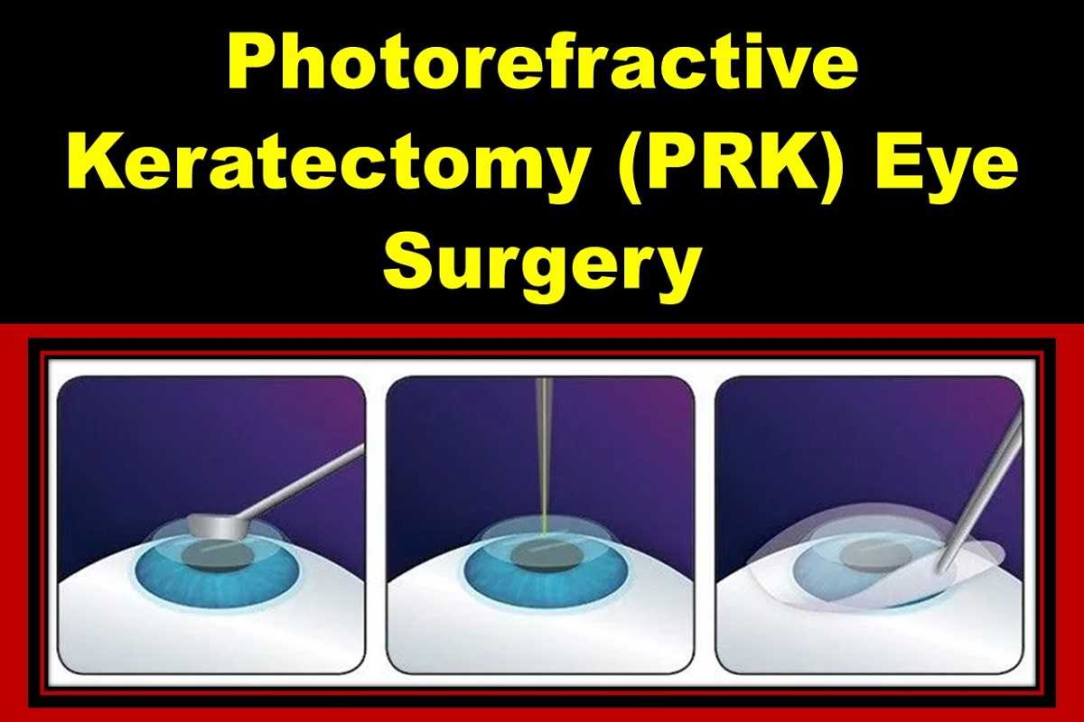 photorefractive-keratectomy-prk-eye-surgery