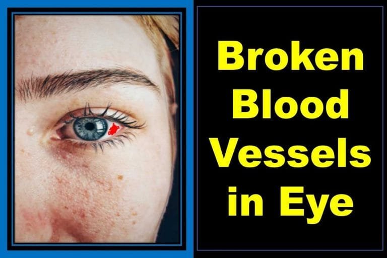 broken-or-popped-blood-vessel-in-eye-causes-healing-health-kura