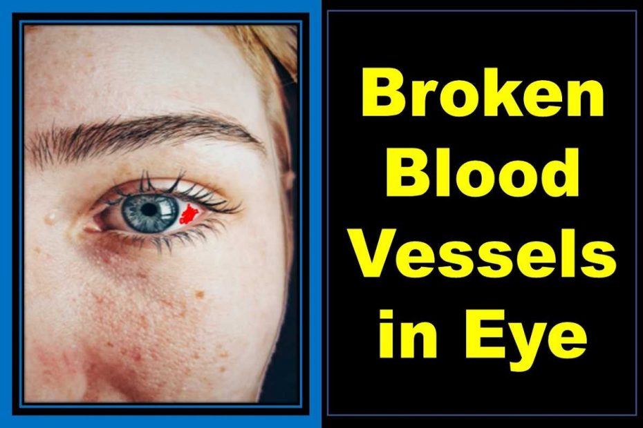 popped-burst-broken-blood-vessels-in-eye-causes-treatment-home-remedies
