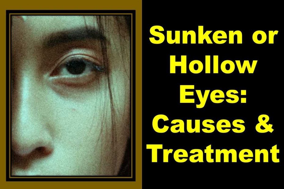 sunken-eyes-hollow-under-eyes-causes-treatment